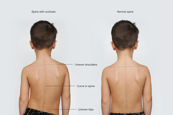 Does my child needs scoliosis surgery?